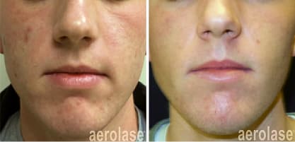 Side-by-side before and after photos of a man's face showing clear improved skin after acne treatment.