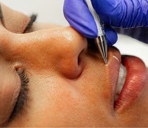 10% off a syringe of dermal filler